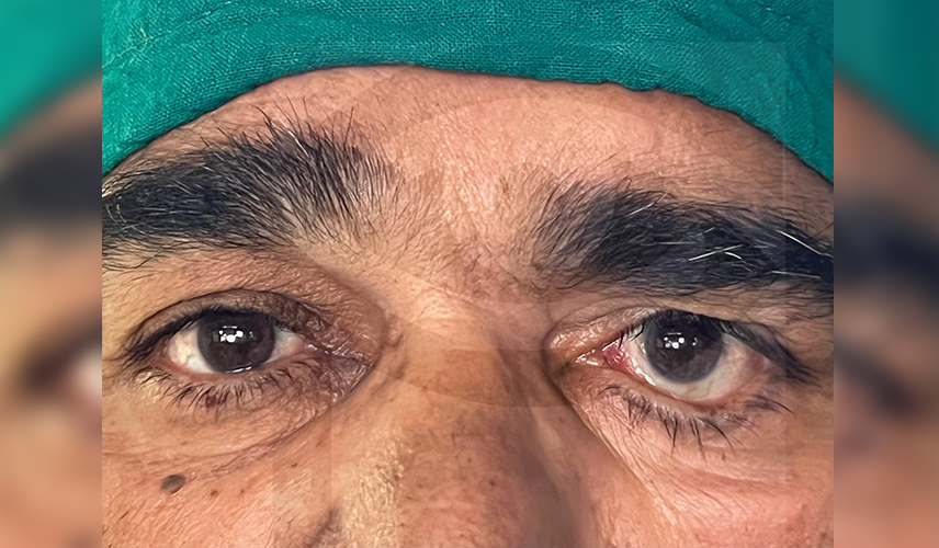 Left lower eyelid ectropion (outward turning of eyelid)