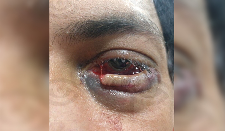 Left inferior eyelid canalicular injury