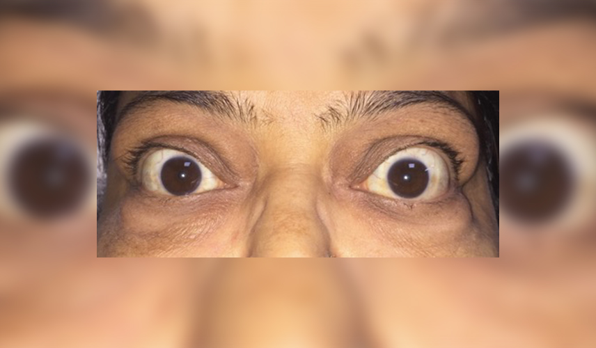 Eyelid retraction and proptosis