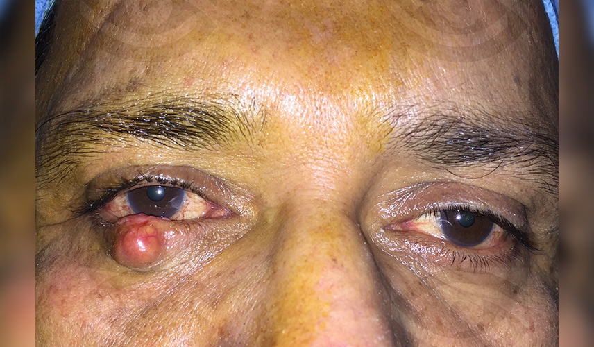 Right lower eyelid sebaceous cell carcinoma
