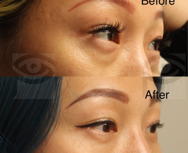 Before and one year after tear trough filler for under eye bags_ hollows