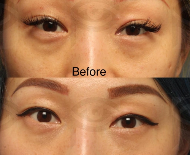 Before and one year after treatment of the tear trough area with hyaluronic acid gel filler