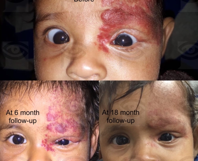 Treatment of capillary hemangioma of the forehead and eyelid with oral medication