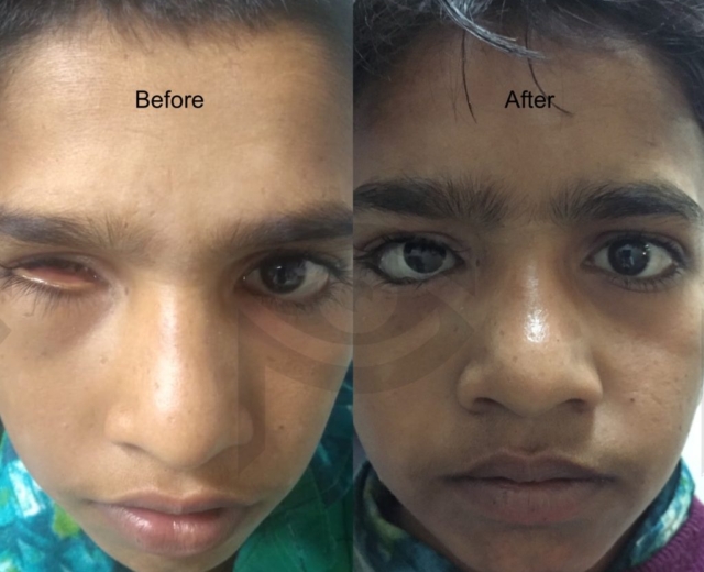 Before and after corrective surgery and artificial eye implanation for right eye microphthalmos with cyst