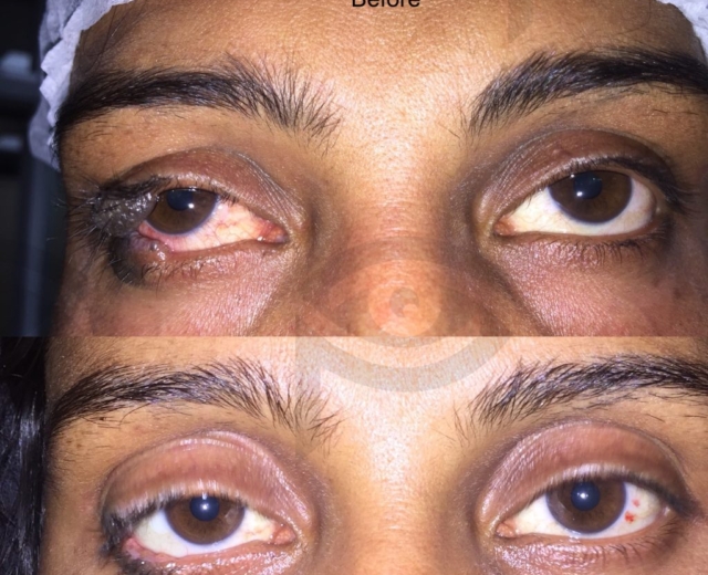 Before and after corrective surgery for eyelid mole ( congenital kissing nevus)