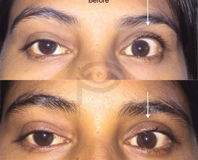 Before and after corrective surgery for left upper eyelid retraction