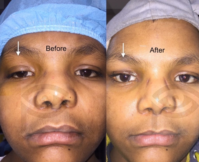 Before and after corrective surgery for right upper eyelid mild ptosis