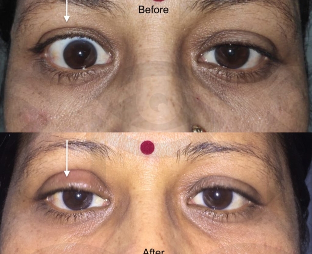 Before and after corrective surgery for right upper eyelid retraction