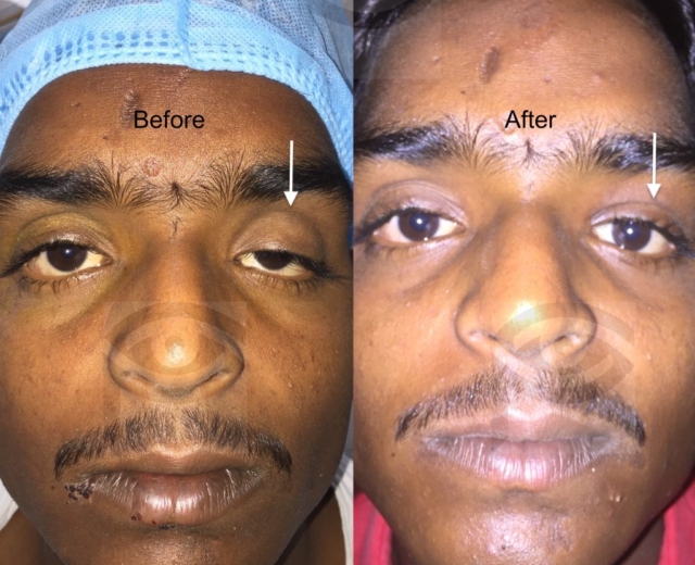 Before and after ptosis correction surgery for left upper eyelid