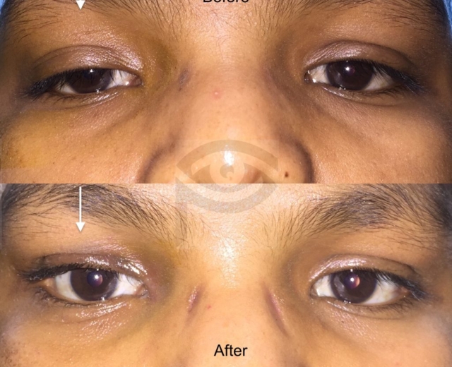 Before and after ptosis correction surgery of right upper eyelid