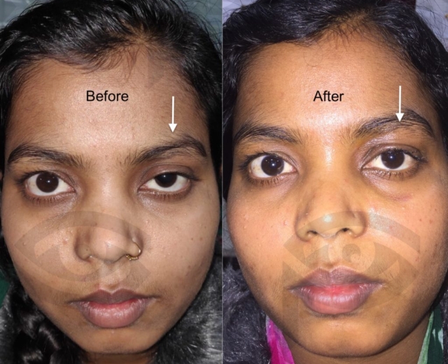 Before and after ptosis surgery for left upper eyelid