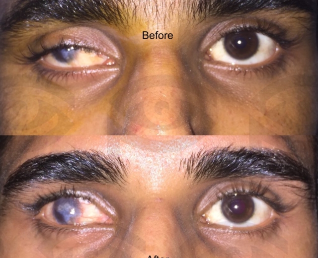 Before and after ptosis surgery for right upper eyelid