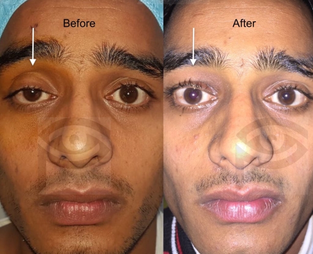 Before and after ptosis surgery of right upper eyelid