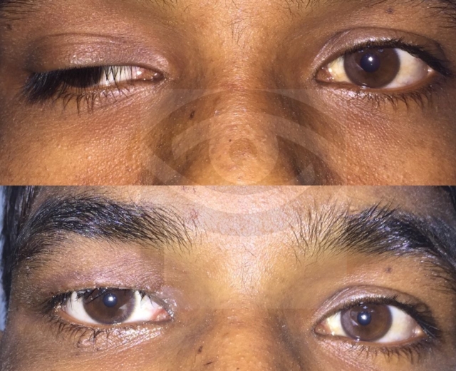 Before and after ptosis surgery of the right upper eyelid