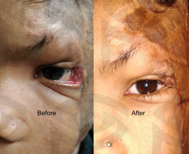 Before and after reconstructive surgery to correct ectropion and reform lateral canthus after a degloving injury