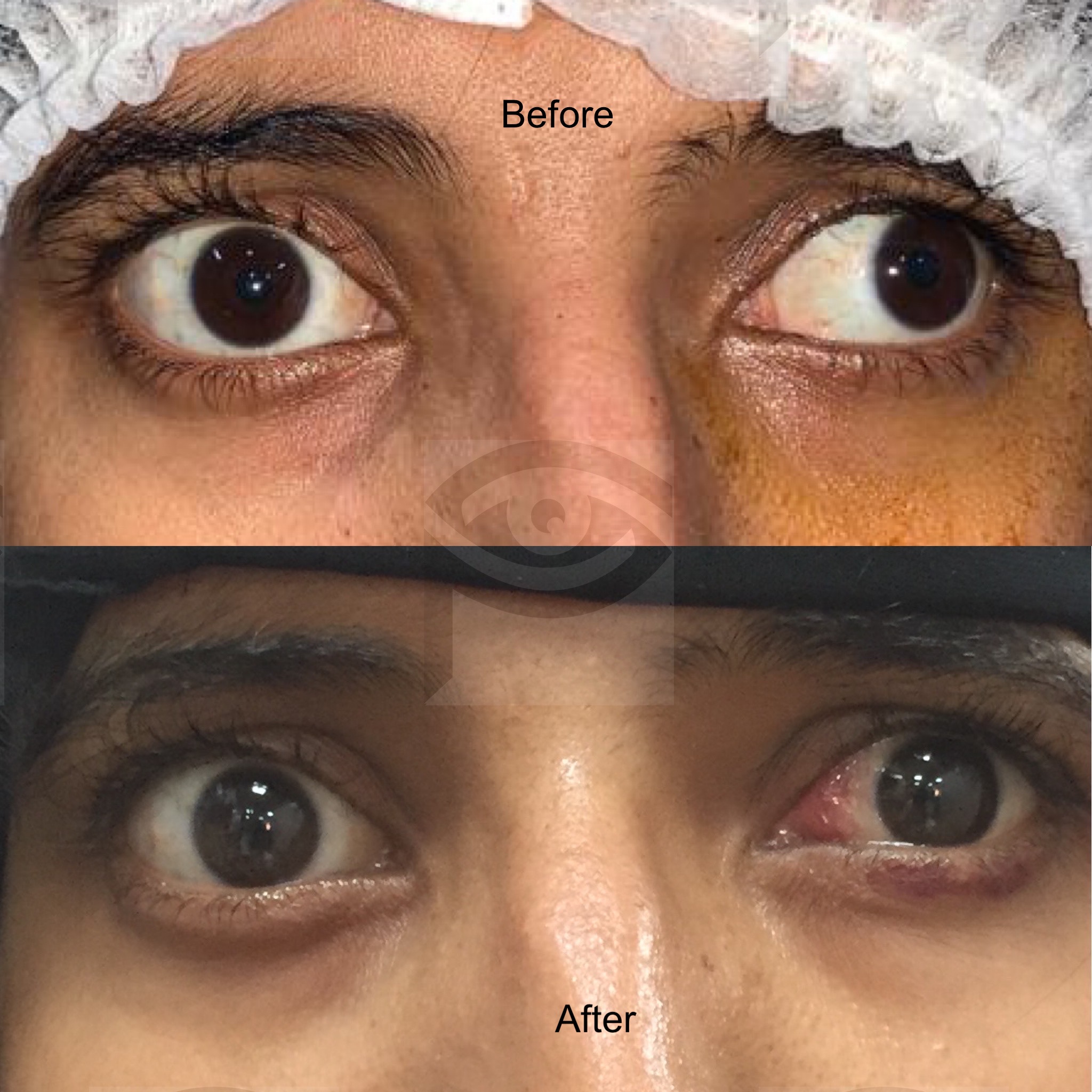 Before After Dr Pallavi Singh MD FICO