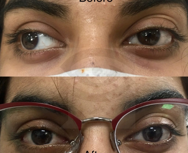 Before and after strabismus surgery for exotropia correction