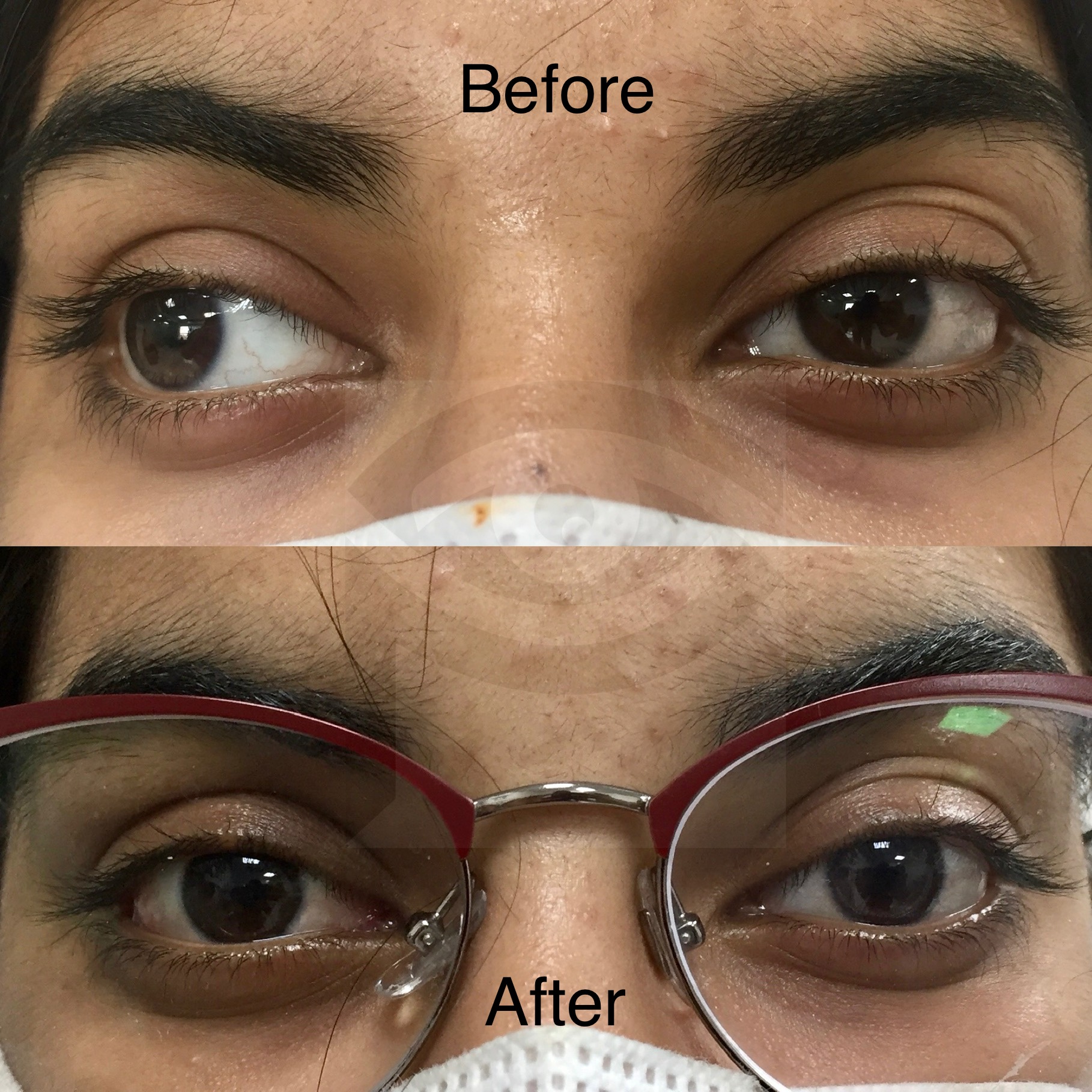 Before After Dr Pallavi Singh MD FICO