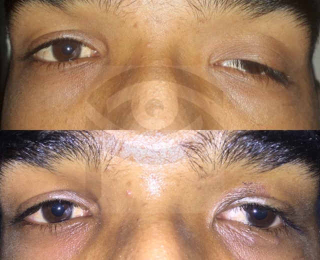 Before and after surgery to correct droopy upper eyelid of the left eye