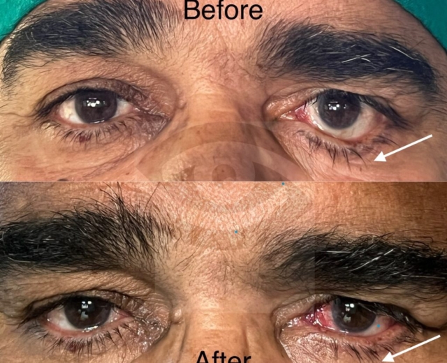 Before and after treatment of lower eyelid ectropion following facial palsy (front view)
