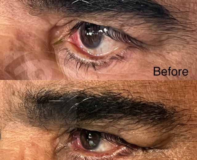Before and after treatment of lower eyelid ectropion following facial palsy (side view)