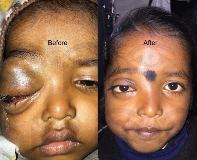 Before and after treatment of right orbitofacial venolymphatic malformation (lymphangioma) with sclerosing injections (bleomycin)