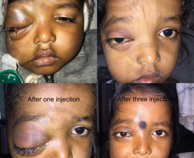 Before and after treatment with sclerosing injections of bleomycin of a right sided orbitofacial venolymphatic malformation (lymphangioma)