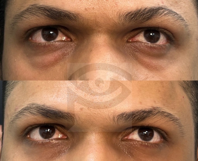 Before and lower blepharoplasty for under eye bags in a young male