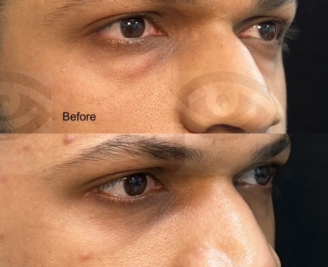 Before and lower blepharoplasty for under eye bags in a young male (side view)