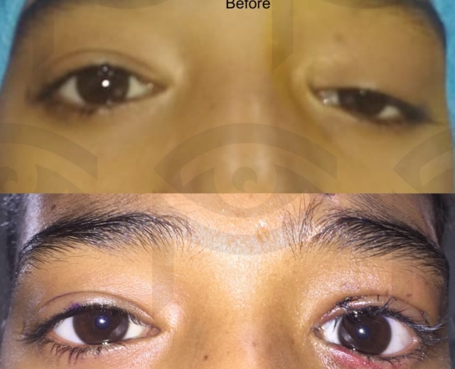 Before and one week after left eye ptosis_drooping eyelid correction surgery.