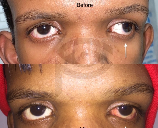Before and one week after strabismus surgery for correction of exotropia