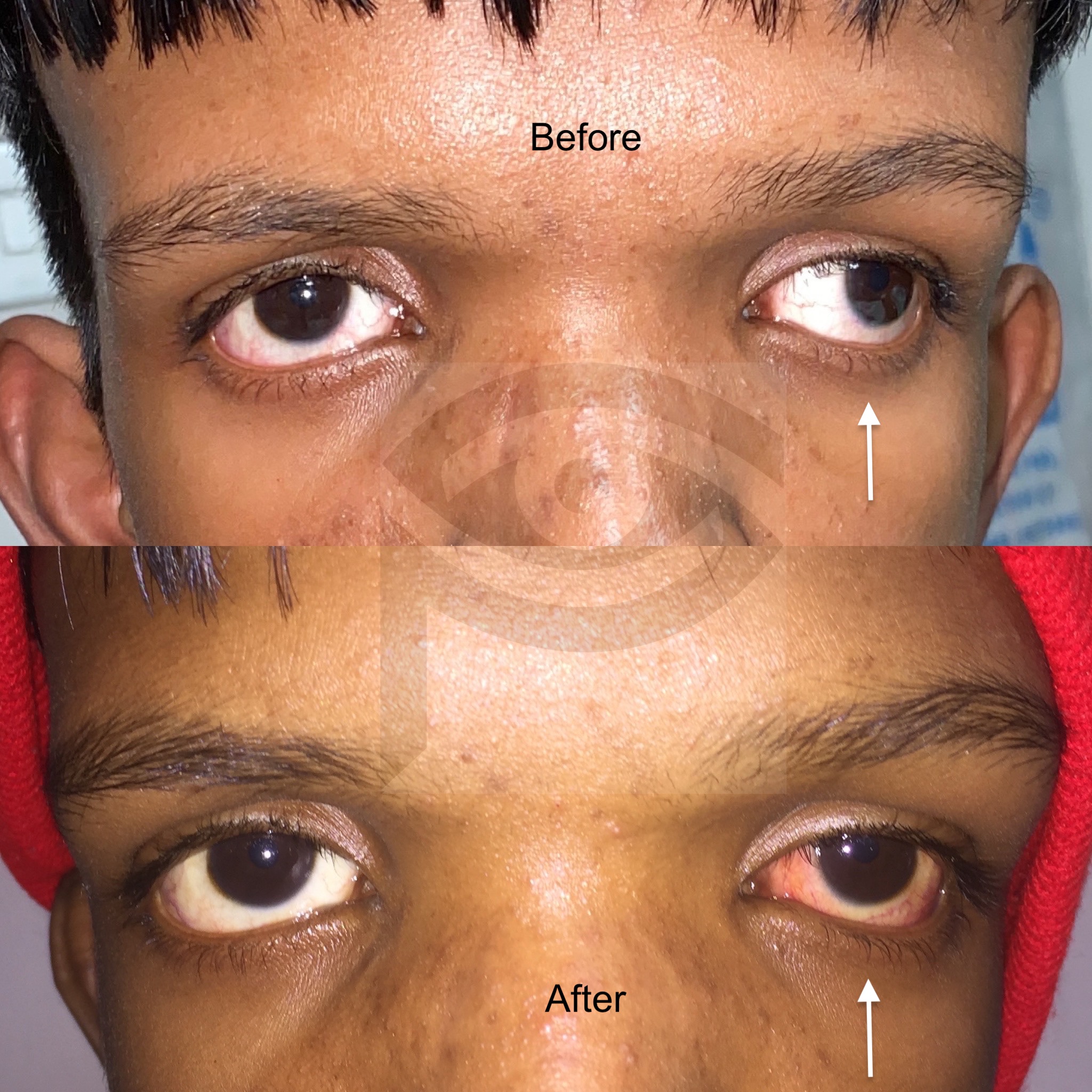 Before After Dr Pallavi Singh MD FICO