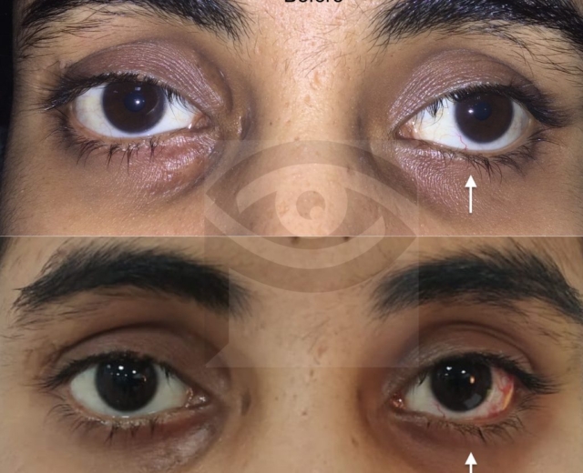 Correction of outwad deviation of eye (exotropia) with squint surgery