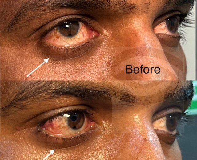 Correction of outward and upward deviation of eye with strabismus (squint) surgery (side view)