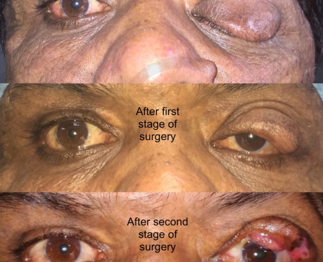 Treatment of eyelid tumor in neurofibromatosis in two stages of surgery. Granuloma seen in the last picture which resolved spontaneously